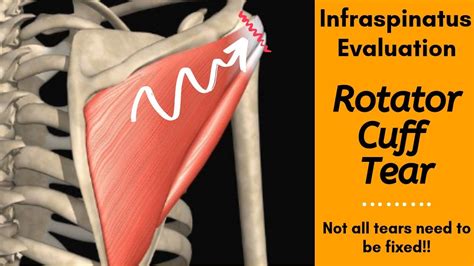 test for muscle tear|extensive tests for strained muscle.